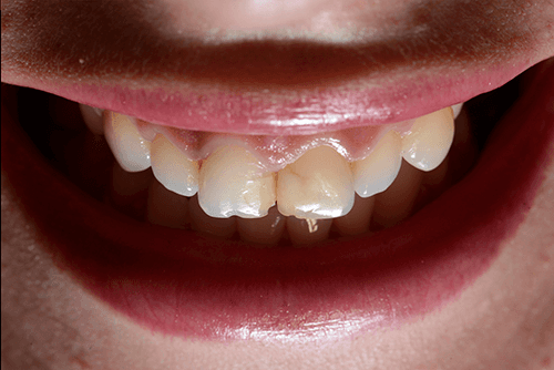 teeth before whitening and veneers