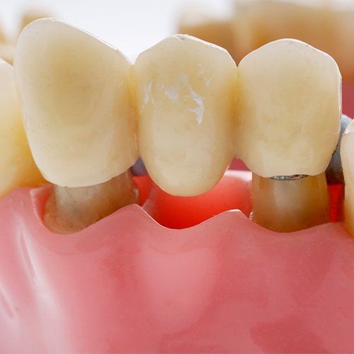 dental crowns and bridges