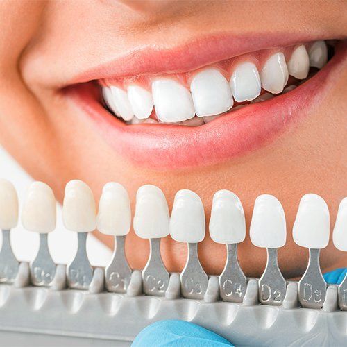 Close-up of a person smiling with bright white teeth, dentist using shade guide to match whiteness.