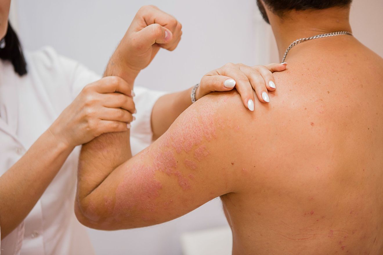 caso di psoriasi