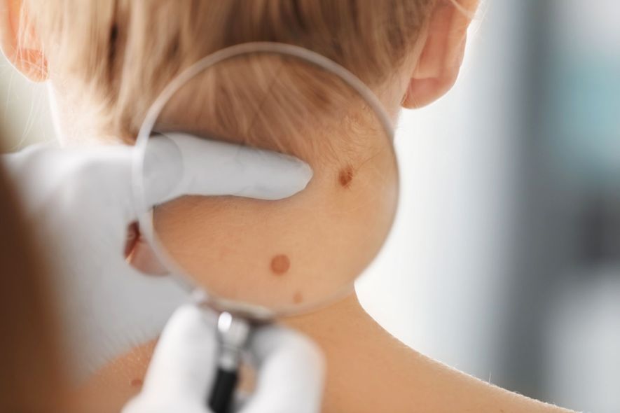 controllo dei nei dal dermatologo