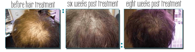 scalp treatment