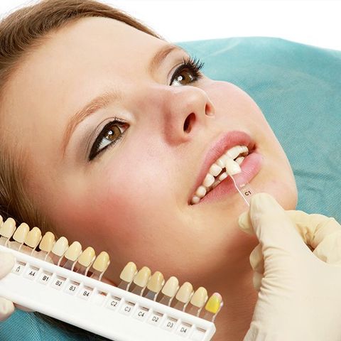 Natural looking veneers