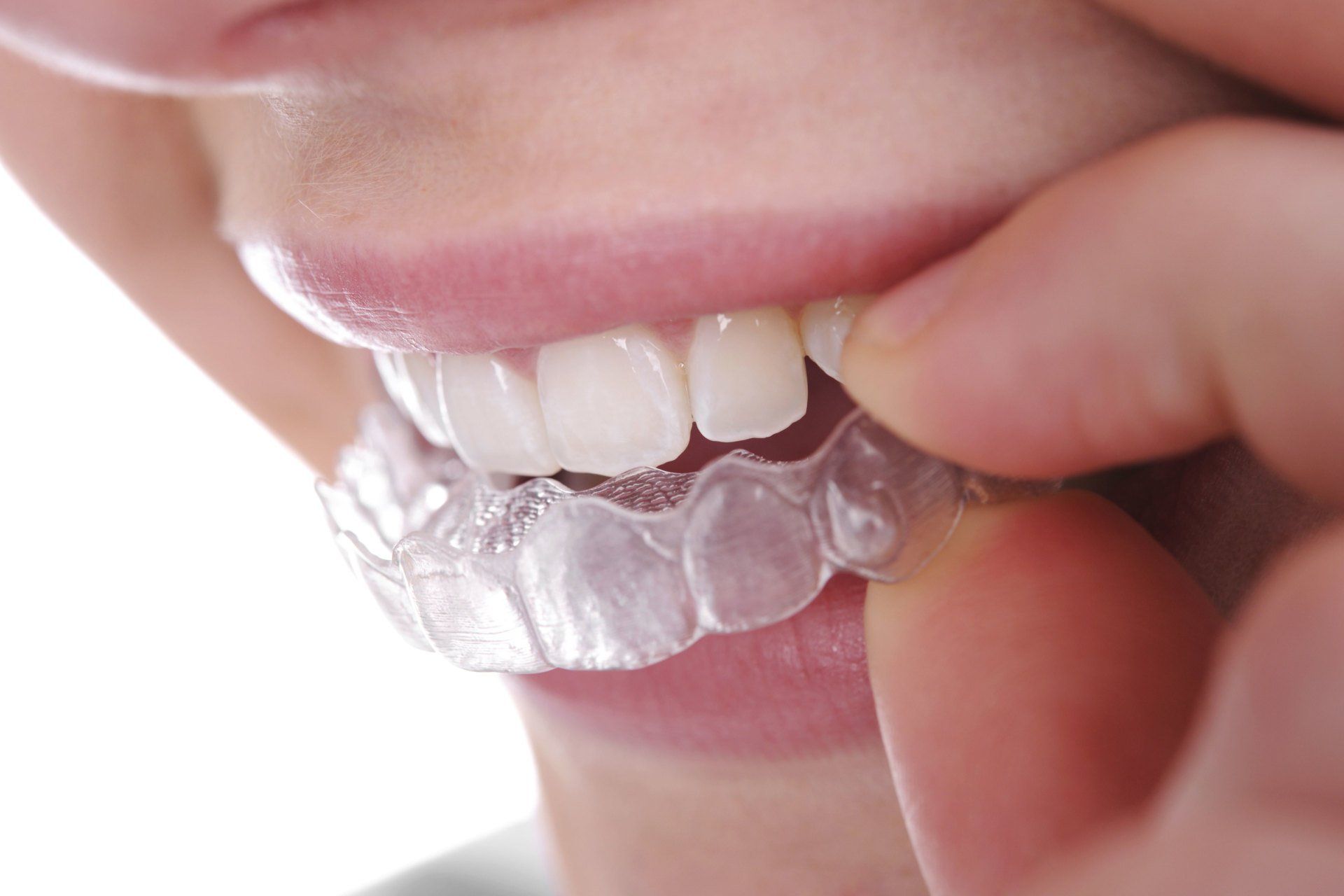 Straight Teeth