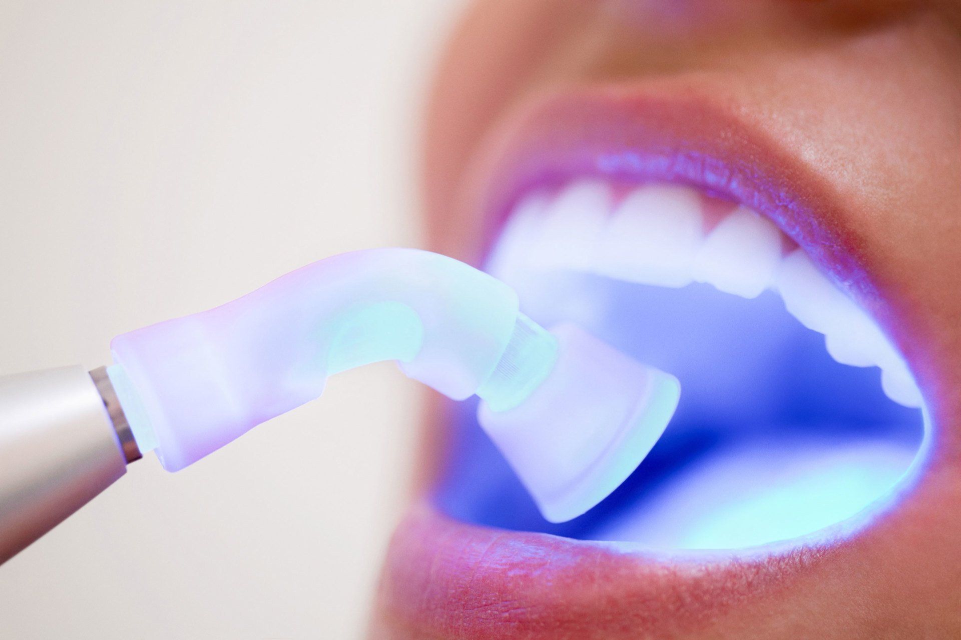 White Fillings