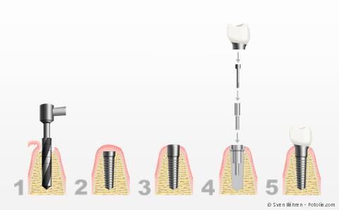 Die meisten Implantate werden im sog. zweiphasigen Verfahren eingesetzt.