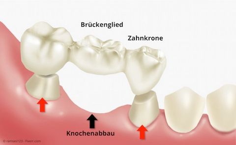 Zahnlücke: Für eine Zahnbrücke müssen (oft gesunde) Nachbarzähne abgeschliffen werden. Zahnlücke: Für eine Zahnbrücke müssen (oft gesunde) Nachbarzähne abgeschliffen werden.