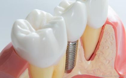Mit der sogenannten Socket Preservation wird dem Abbau der Kiefer nach Zahnverlust vorgebeugt.