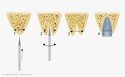 Bone Spreading: Ein zu schmaler Kieferkamm wird im Bereich des Implantats verbreitert Bone Spreading: Ein zu schmaler Kieferkamm wird im Bereich des Implantats verbreitert