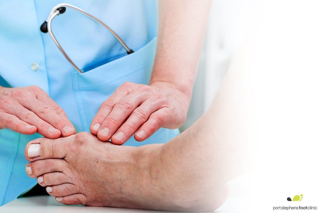 Bunions Newcastle Podiatry