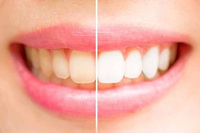 Close-up teeth female between before and after brush the teeth. - Dentists in Carneys Point, NJ Close-up teeth female between before and after brush the teeth. - Dentists in Carneys Point, NJ