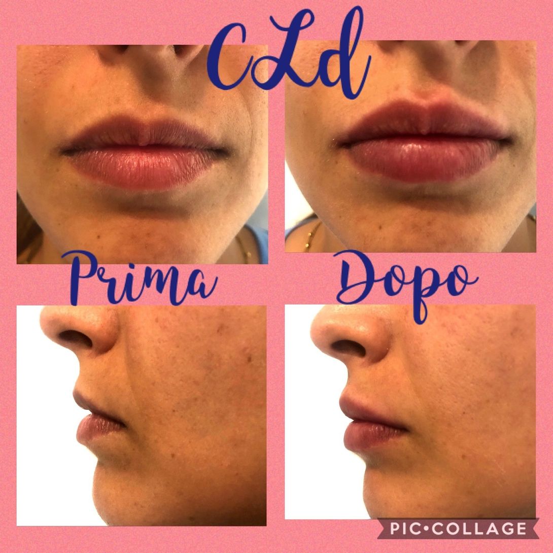Trattamento filler
