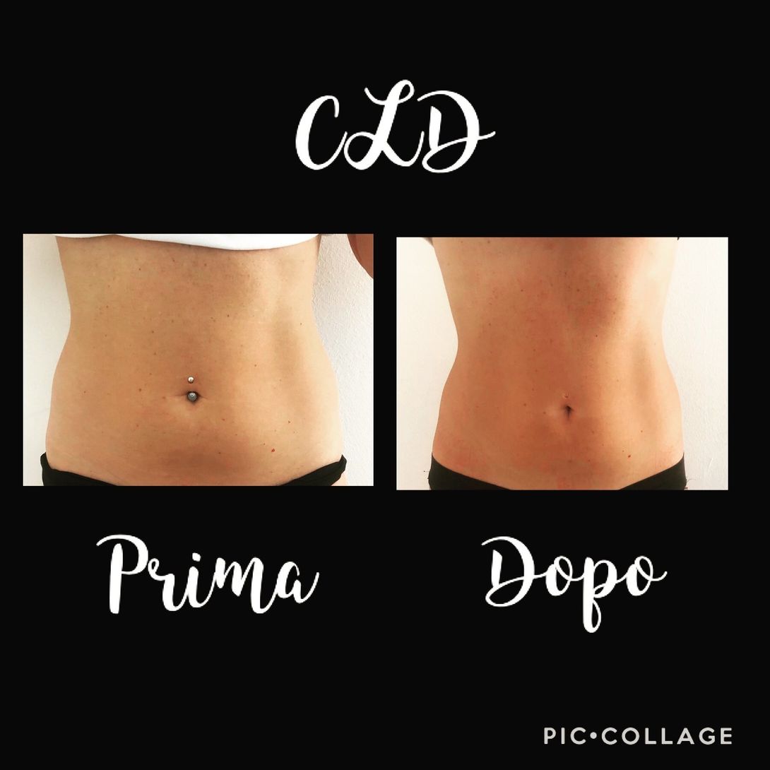 Intralipoterapia