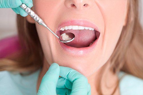 Tooth Colored Fillings patient at Galvez Dentistry
