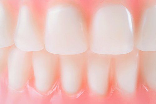 Dental Bonding patient at Galvez Dentistry