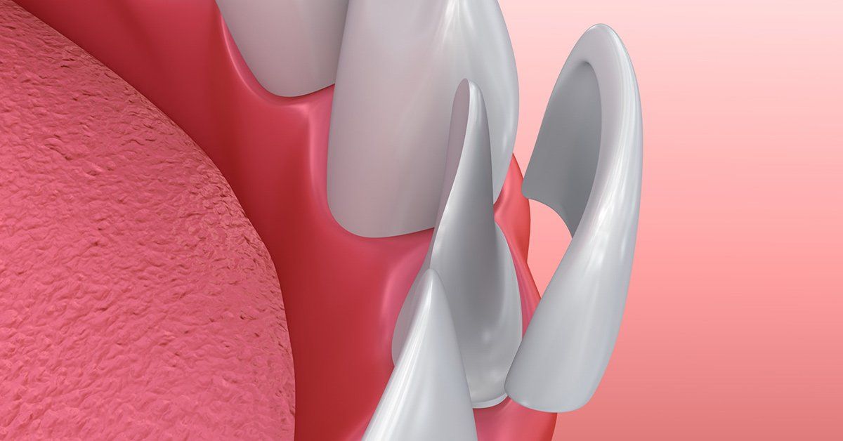 guide on dental veneers