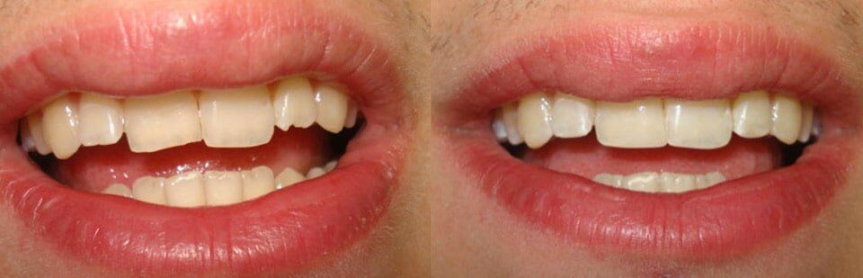 Before and After 11 — General Dentistry in Tallahassee, FL