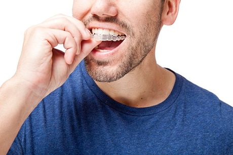 man putting on invisalign