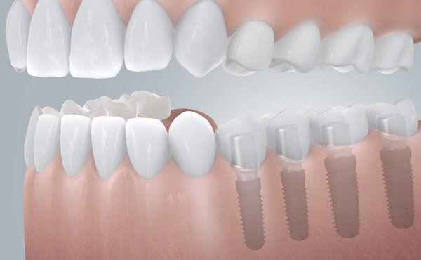 Implantate im Unterkiefer statt Prothese