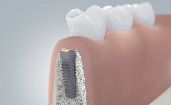 Implantat im Unterkiefer mit seitlicher, lateraler Knochenanlagerung, Knochenaufbau.