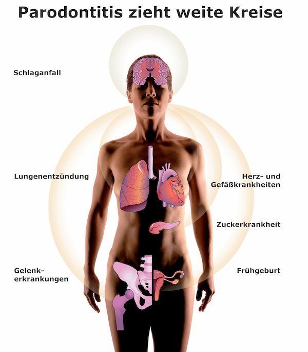 Parodontitis und die Auswirkungen auf den Körper und die Allgemeingesundheit