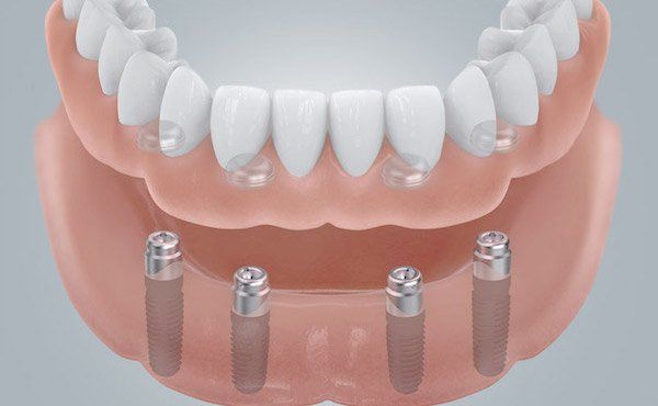 Prothese im Unterkiefer mit Implantaten verbunden