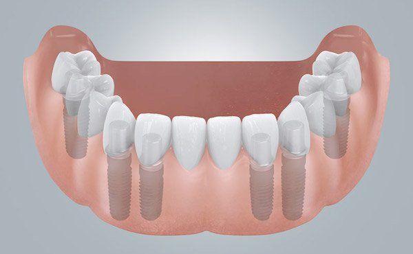 Brücken auf Implantaten im Unterkiefer statt Totalprothese