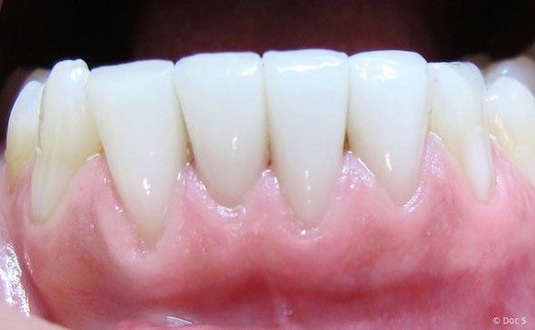 Veneers im Unterkiefer