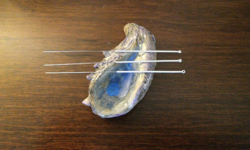 acupuncture methods