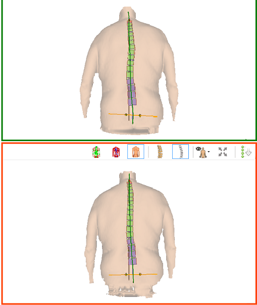 Back-view medical scan of a torso with a colored spine overlay, shown in two stacked panels.