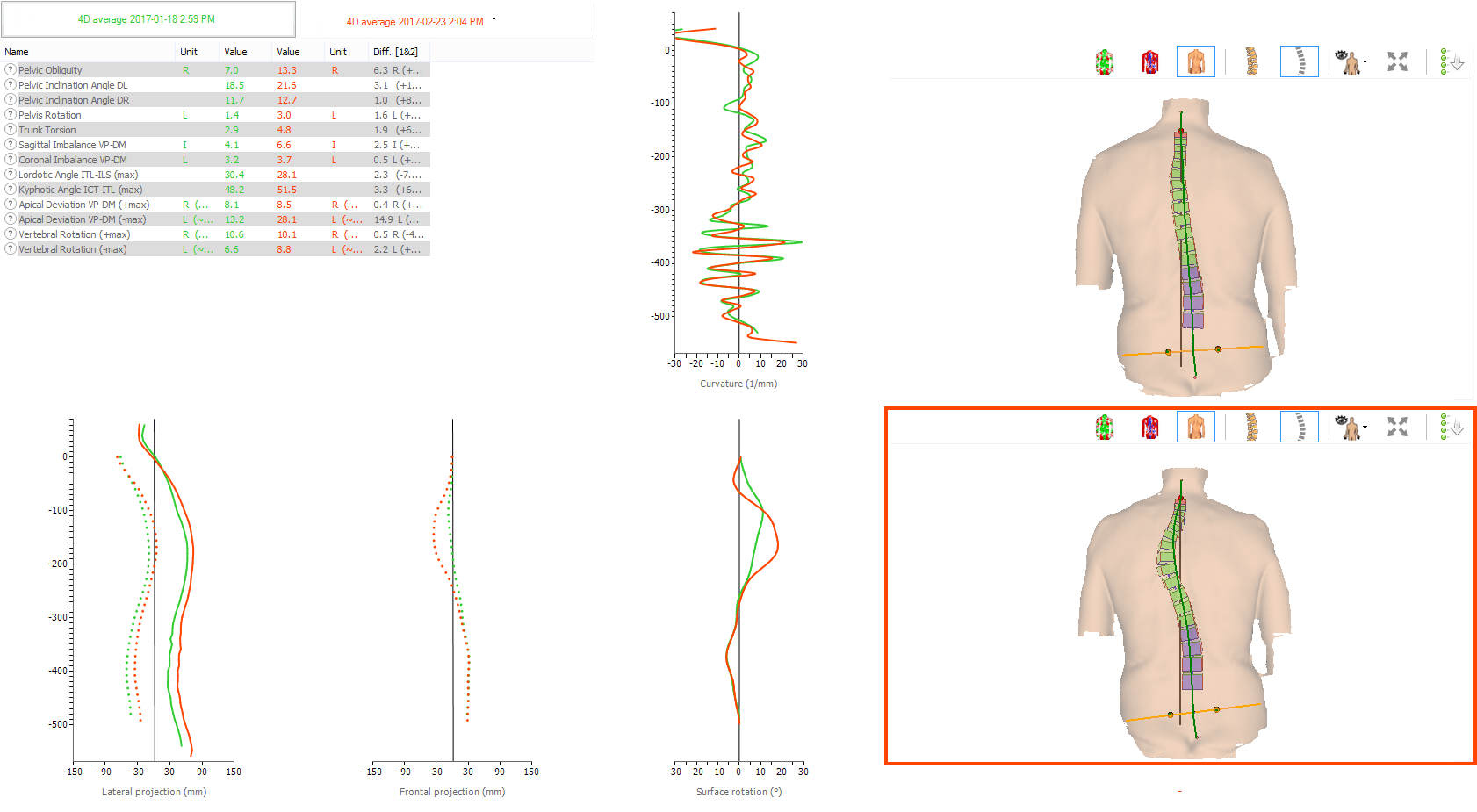 Medical posture-analysis report with charts and front/back body alignment markers.