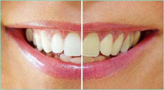 Teeth with brush — Dental Care Service in Cambridge, MN Teeth with brush — Dental Care Service in Cambridge, MN