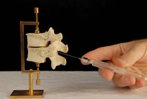 Vertebre con ernia