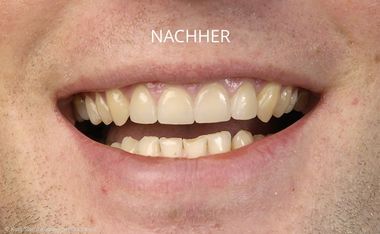 Schneidezähne nach der Behandlung mit Veneers Schneidezähne nach der Behandlung mit Veneers