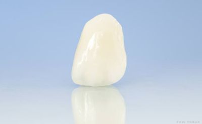 Veneers: Hauchdünne Schalen, die auf den Zähnen befestigt werden und ihnen ein natürliches Aussehen geben