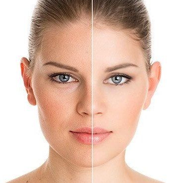 Side-by-side facial comparison showing natural complexion on left and smoother skin on right.