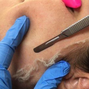 Close-up of a facial dermaplaning procedure with a metal blade and gloved hands scraping skin.