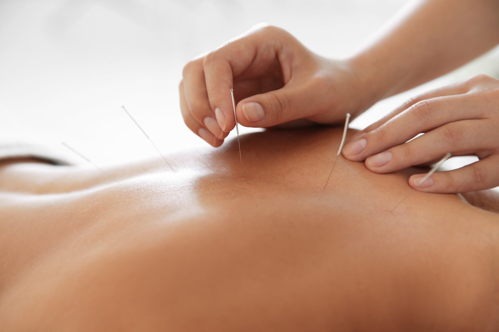 acupuncture sante globale