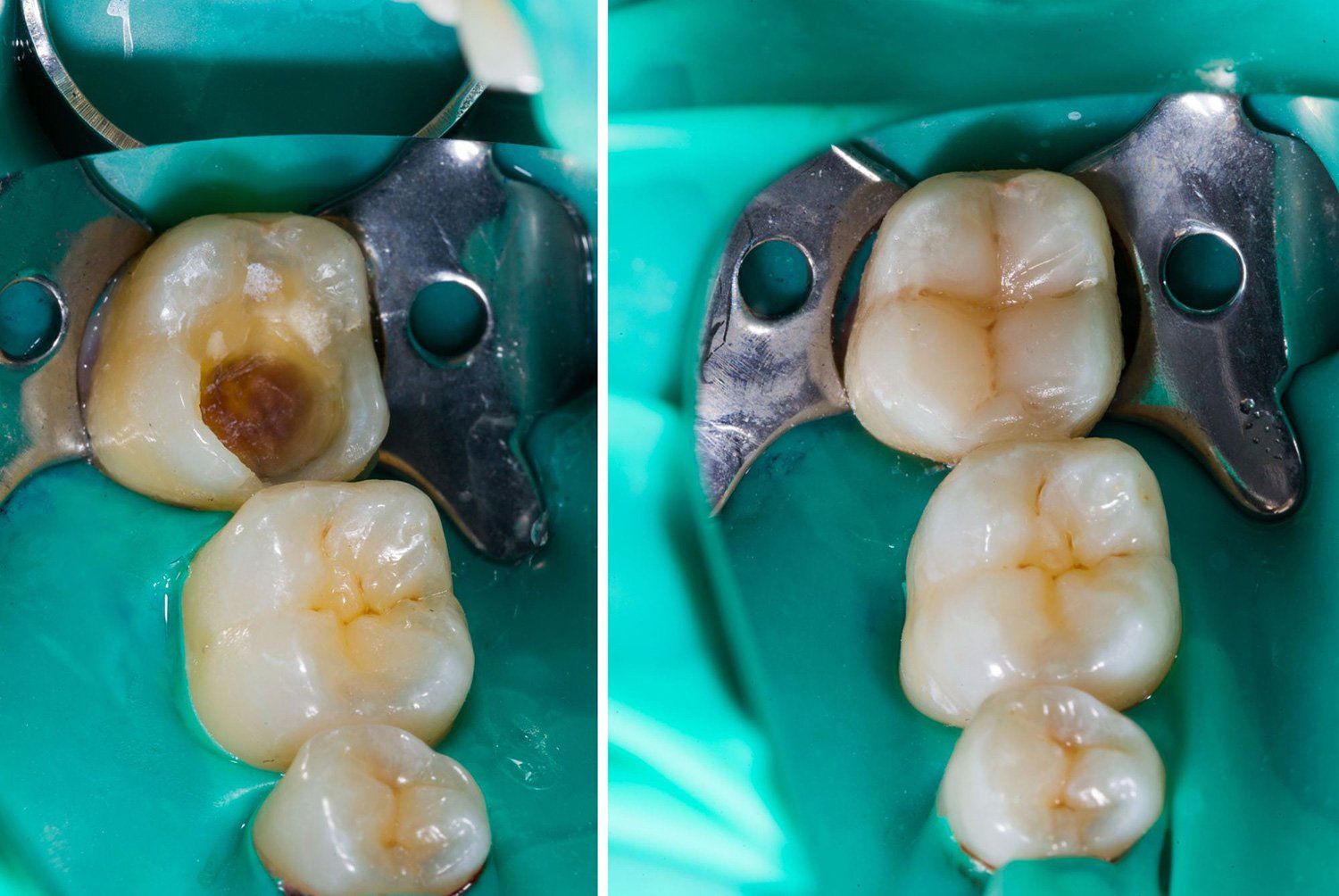 otturazioni estetiche