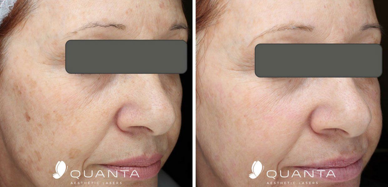 Rosacea Treatments Before and After Pictures At Maryland