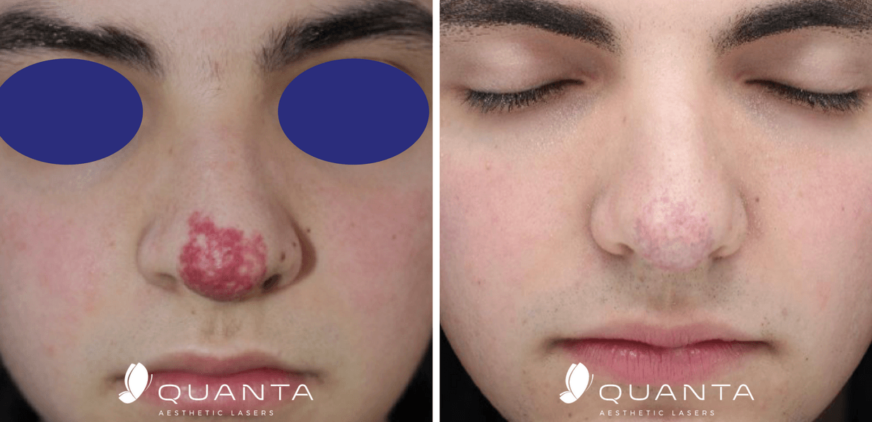 Rosacea Treatments Before and After Pictures At Maryland