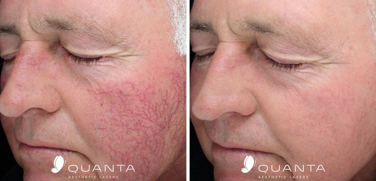 Rosacea Treatments Before and After Pictures At Maryland