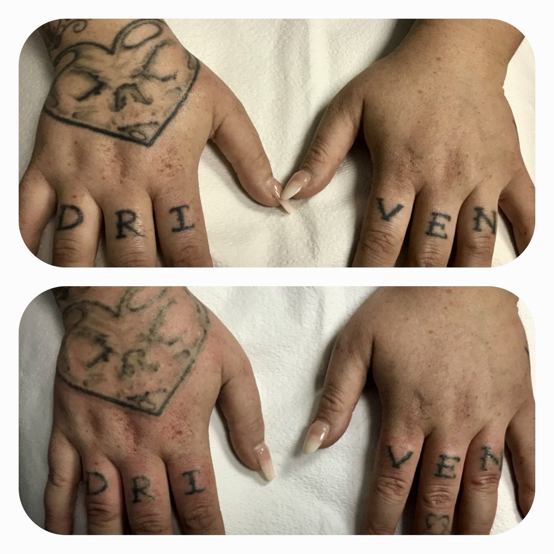 Laser Tattoo Removal In Maryland