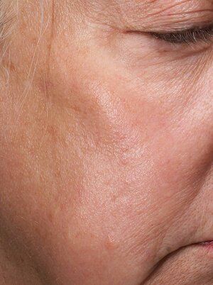 skin resurfacing