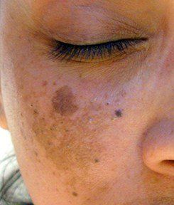Melasma Treatment at Women's Health Services of Maryland