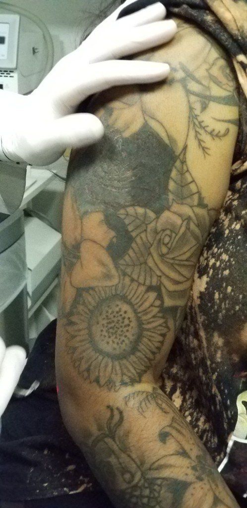 Laser Tattoo Removal In Maryland