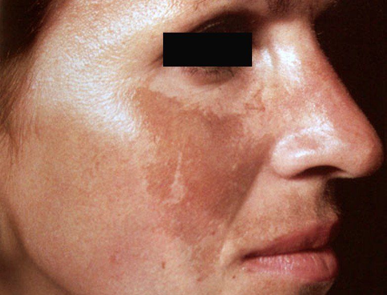 Melasma Treatment at Women's Health Services of Maryland