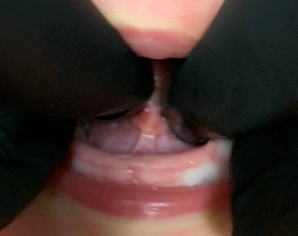 lip and tongue tie surgery in Hammond LA | Pediatric Dentist