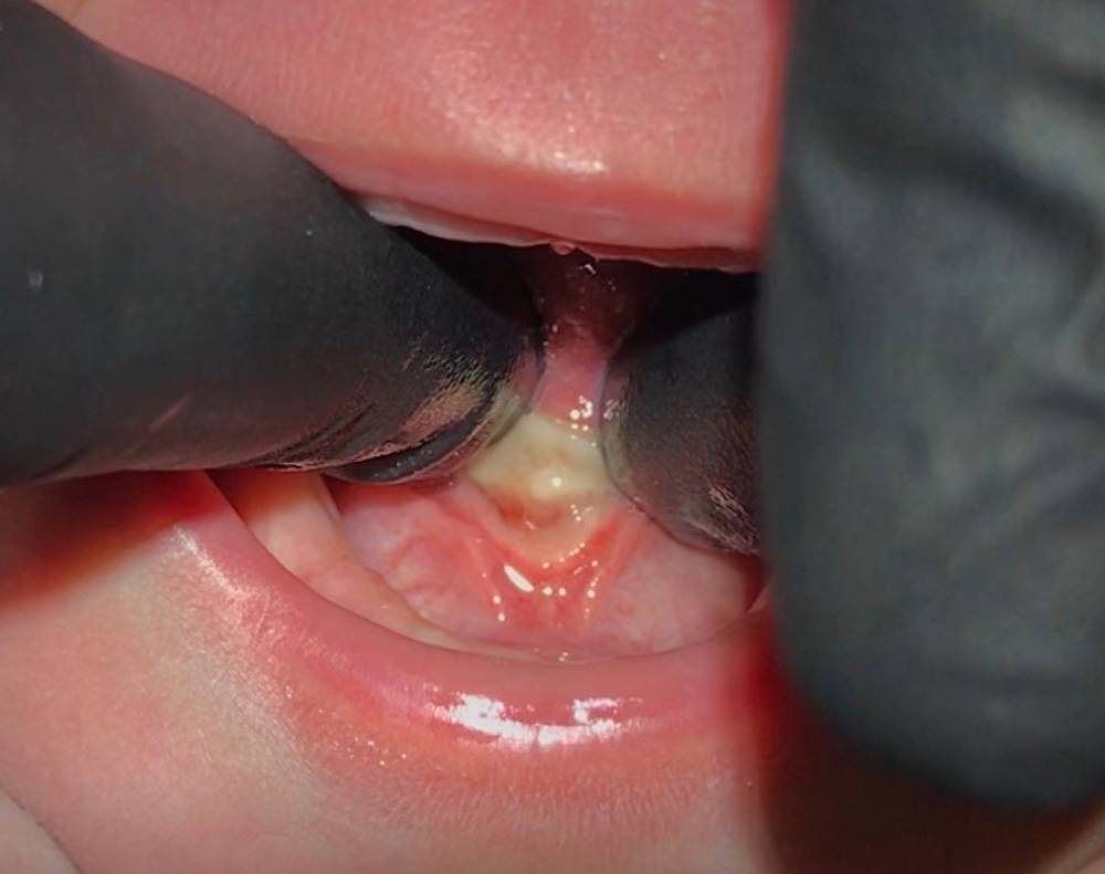 Best Pediatric Dentist | Lip and tongue ties in Hammond LA 70401