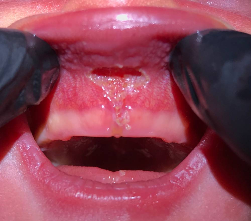 After lip tie release at our pediatric dental practice in Hammond LA After Lip Tie Release | Children's Dentist in Hammond LA